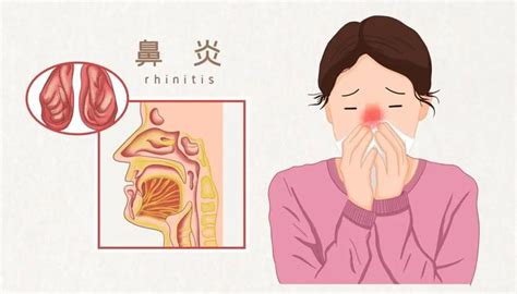 警惕！鼻炎久治不愈，小心拖成慢性病！专家教你3招有效缓解鼻塞、流涕。 - 知乎