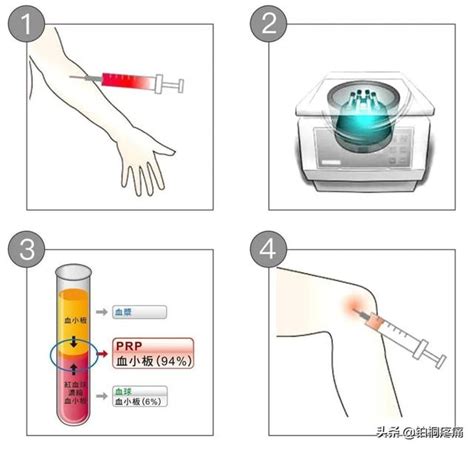 “一针”治好骨关节炎，自体生长因子（PRP 技术)是怎么一回事？|血小板|骨关节炎|因子_新浪新闻