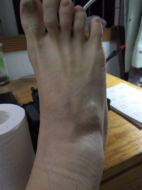 脚肿图片