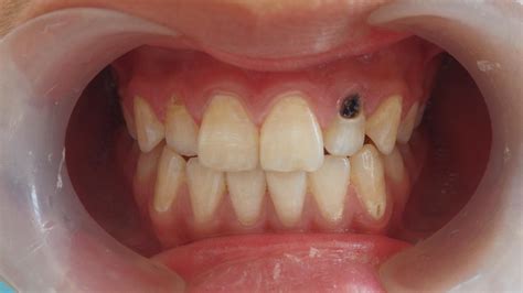 宝宝8岁门牙掉了半年没长，牙医解释此情况正常吗？是缺钙吗？_口腔行业资讯_皓齿口腔网