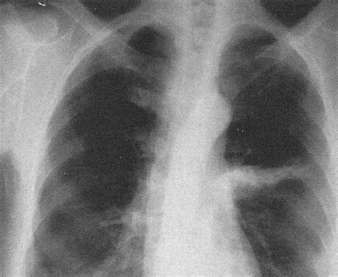 图2—289 左肺上叶肺炎恢复期-胸部X线影像学图鉴-医学