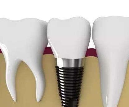 牙贝恩口腔是正规牙科连锁,种植牙/牙齿矫正技术和价格靠谱,种植牙-8682整形网