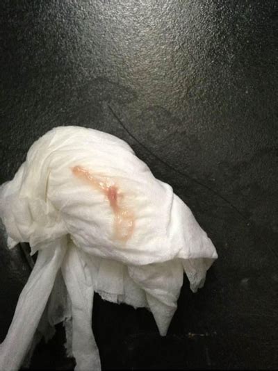 有炎症的白带图片