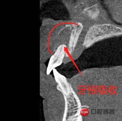 前牙区根尖囊肿刮治术记录（有图）-贵阳胡松牙医的博客-KQ88口腔博客
