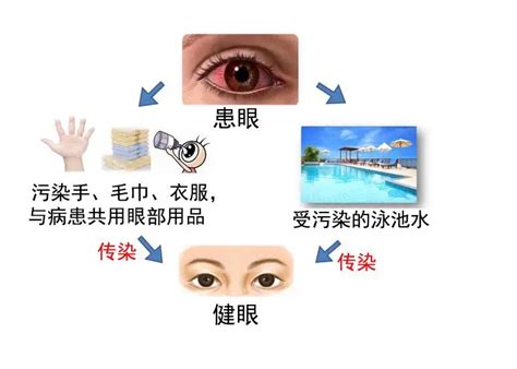“红眼病”看一眼就会被传染？真相在这里！_广东省疾病预防控制中心网站