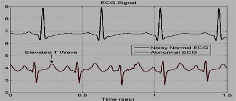 A Normal Vs abnormal ECG | Download Scientific Diagram