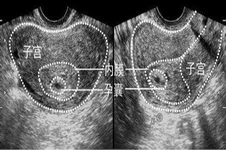 胎儿的性别预测，孕囊的形状看男女真的准吗|长和|孕囊|形状_新浪新闻