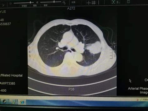 一篇读懂肺癌——肺癌的流行病学现状-京东健康