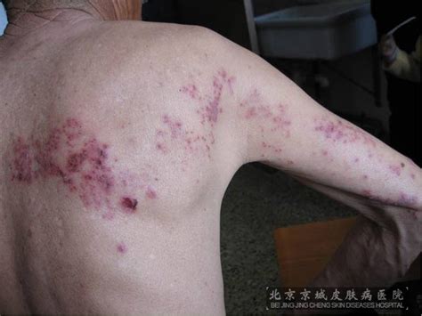 带状疱疹的临床症状有什么_带状疱疹_北京京城皮肤医院(北京医保定点机构)