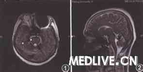 多图多表丨一文总结：小脑疾病的临床和影像学表现_小脑疾病_影像学_医脉通