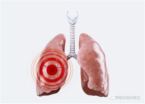 肺癌初期有哪些迹象？医生：出现这4种症状，越早查肺CT越好|肺癌|症状|患者_新浪新闻