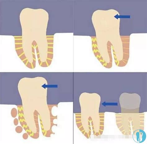 牙齿松动的治疗方法-爱康健齿科