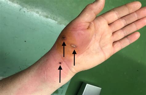 猫咬伤后，手部感染快速进展1例_经典病例_医脉通
