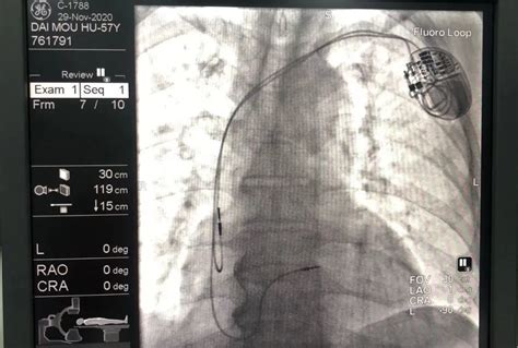 心脏起搏器植入手术过程_腾讯视频