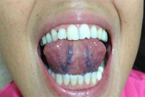舌头下有青筋是怎么回事？或预示此种病症，2个方法助你缓解|青筋|舌头|淤血_新浪新闻