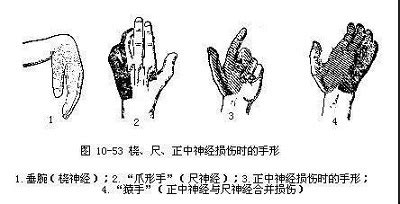 爪形手垂腕猿手,爪形手垂腕猿手,爪形手和猿手_大山谷图库