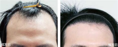 江西植发案例-种植头发-对比效果图-发友网