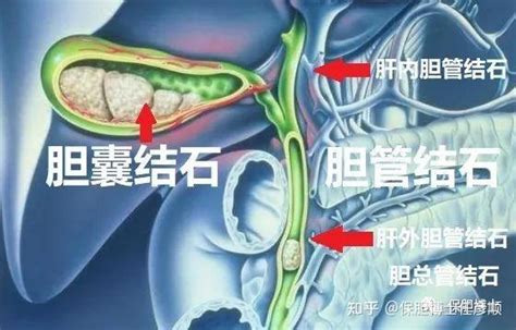 造成胆管堵塞的原因有哪些？无非就这3个，别大意了