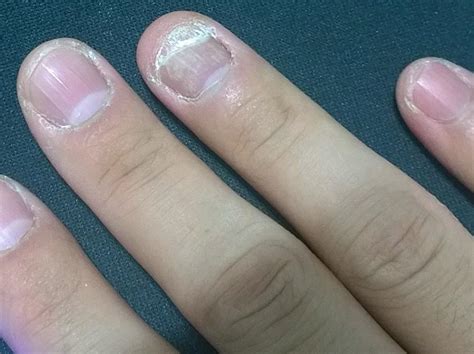 “灰指甲”会造成哪些伤害？这四点重视起来，正确预防！__凤凰网