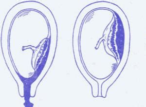 孕期前置胎盘与后置胎盘的区别和危害你知道多少？