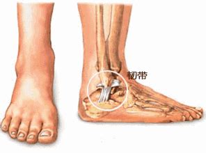 病症：脚扭伤也要打石膏，医生是不是搞错了_医数