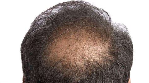 科学家称新疗法可让脱发患者头发再生 – 肽度TIMEDOO
