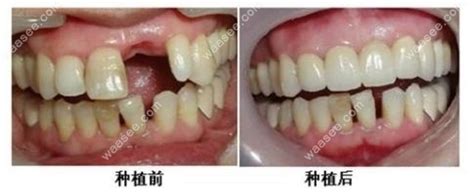 2023北京口腔医院种牙价目表,单颗|半口|全口种植牙价格都有,专家提醒-8682赴韩整形网