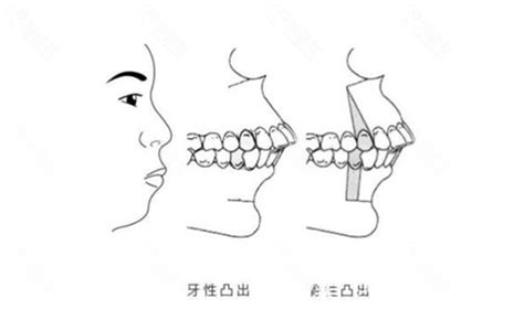 骨性凸嘴做正颌手术的脸型变化图可以从手术视频看出来哦整形案例 - 广西南宁爱思特整形外科医院 - 炫美网