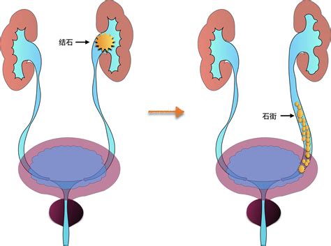 尿路结石形成石街是怎么回事，怎么办？-有来医生