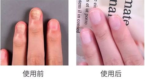 我的指甲缝怎么又红又肿？| 果壳 科技有意思