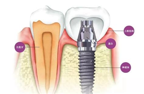 全口种植牙的难点和解决方案 口腔修复工艺网