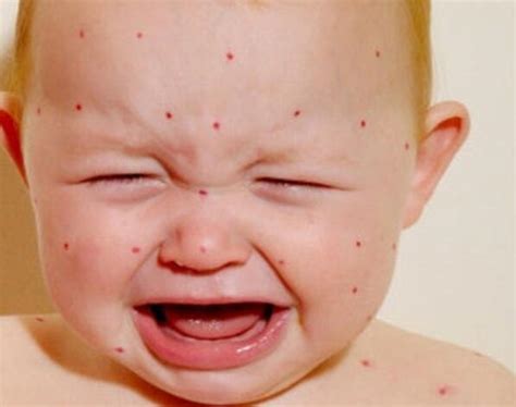 宝宝脸上起红疹,宝宝脸上起小红点,脸上起红疹(第2页)_大山谷图库