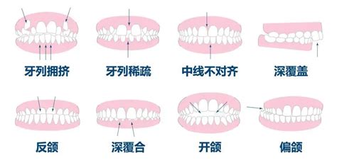 牙齿侧面图,标准的牙齿咬合侧面图,正常牙齿侧面图_大山谷图库
