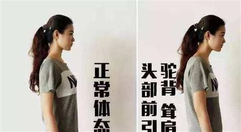 含胸驼背图片