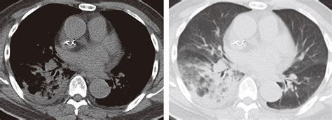 肺磨玻璃结节典型病例分享+患者需要上传什么样的照片 - 微医（挂号网）