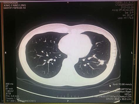 肺癌中的小众群体——大细胞肺癌，确实不可忽视的癌种，怎样治疗 - 知乎
