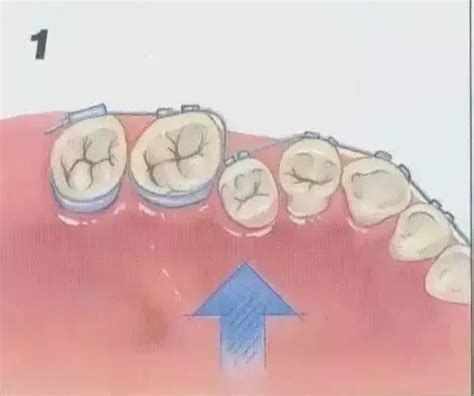 牙齿矫正过程动图图片
