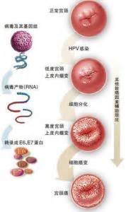HPV病毒 - 搜狗百科