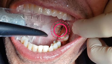 Preventing Patient Aspiration in Dental Procedures • Zyris