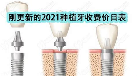 刚更新的2021种植牙收费价目表,曝光2021种植牙齿多少钱一颗？_口腔行业资讯_皓齿口腔网