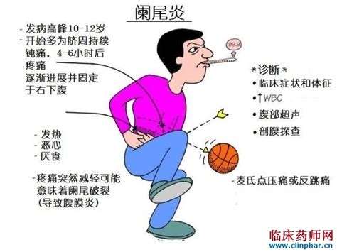 阑尾位置示意图图片
