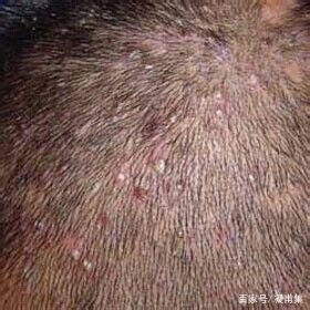 头皮脂溢性皮炎能经常洗头吗？需要注意什么？_凤凰网视频_凤凰网