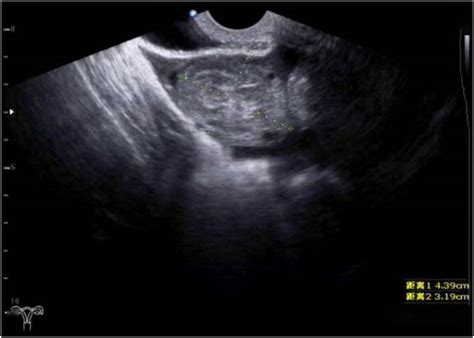 卵巢黄体破裂误诊卵巢肿瘤1例-医联