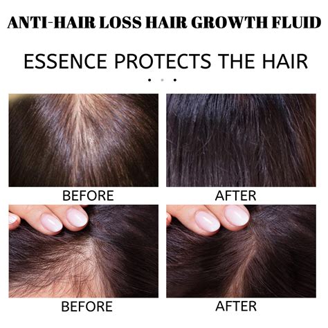 男女生头发自然生长增长液增发密发际线后移生发剂长发毛发非快速