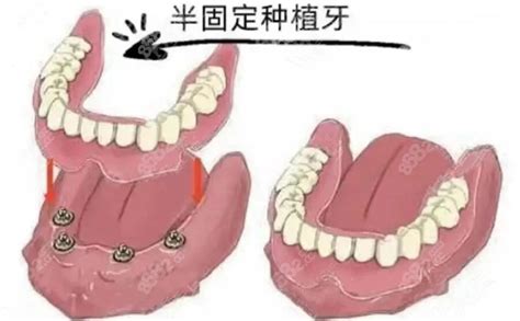 可乐牙后续戴牙效果左上2瓷贴面备牙-青岛牙医 王文泽的博客-KQ88口腔博客