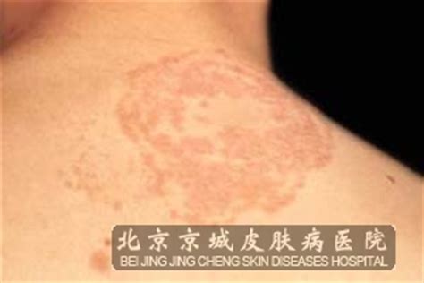 体癣的鉴别诊断方法是什么_体股癣_北京京城皮肤医院(北京医保定点机构)
