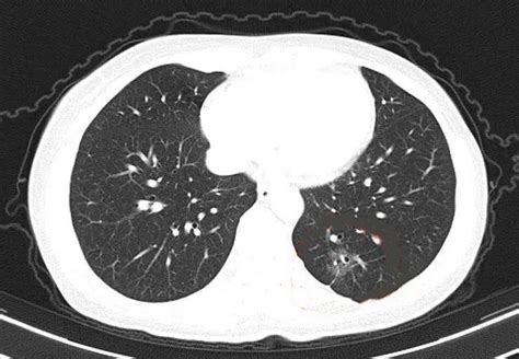 都是肺癌中的鳞癌，为何一个3年复发，一个6年正常？ - 知乎