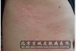 胆碱能性荨麻疹的六种偏方_荨麻疹_北京京城皮肤医院(北京医保定点机构)