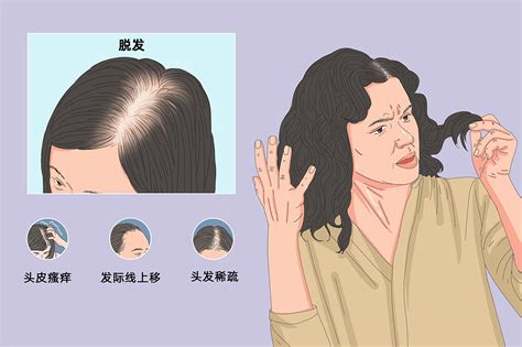刘爱民教授皮肤病辨治典型案例分享(56)雄激素性脱发一例_患者_治疗_毛发