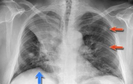 【肺部有阴影】【图】肺部有阴影应如何治愈 引起“肺部阴影”的疾病有哪些(3)_伊秀健康|yxlady.com